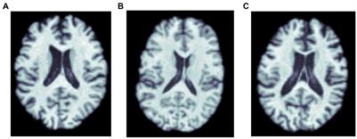 Comparison of deep learning architectures for predicting amyloid positivity in Alzheimer’s disease, mild cognitive impairment, and healthy aging, from T1-weighted brain structural MRI